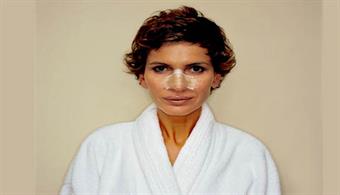 جلوگیری از خونریزی بعد از عمل بینی